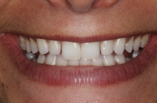 A Treatment Alternative for Retained Primary Molars Lavigne treatment alternatives retained molars 01