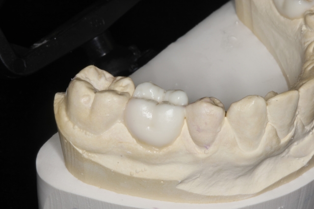 A Treatment Alternative for Retained Primary Molars Lavigne treatment alternatives retained molars 03