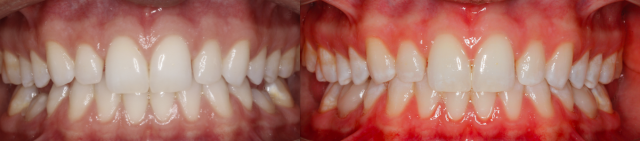 A Treatment Alternative for Retained Primary Molars Lavigne treatment alternatives retained molars 05