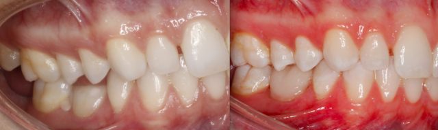 A Treatment Alternative for Retained Primary Molars Lavigne treatment alternatives retained molars 06