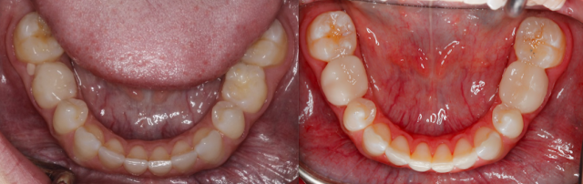 A Treatment Alternative for Retained Primary Molars Lavigne treatment alternatives retained molars 07