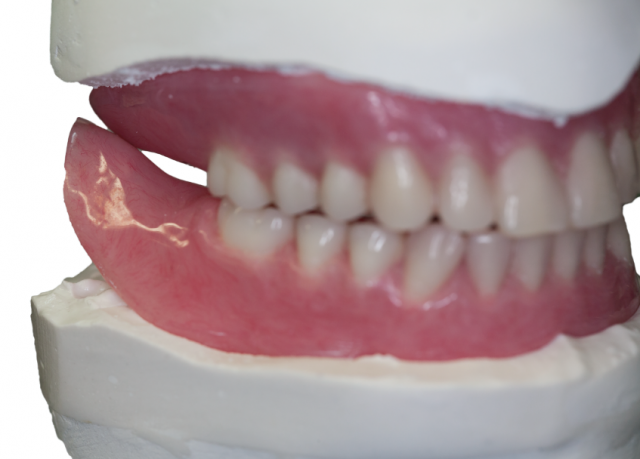 3 Key Clinical Steps for Successful Denture Insertion image 21