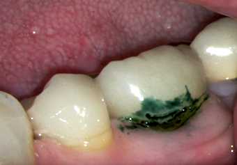 Is It a Good Idea To Repair Crown Margins? image 23