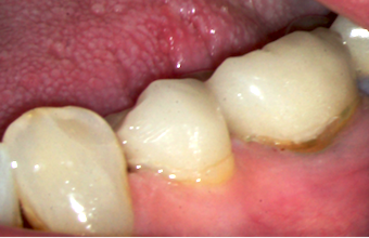 Is It a Good Idea To Repair Crown Margins? image 24