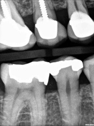 Caries Detection, Part I: What Do You See? image 11