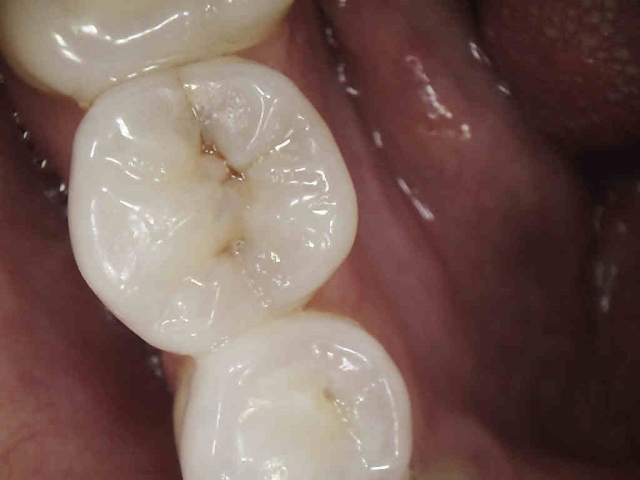 Caries Detection, Part I: What Do You See? image 12
