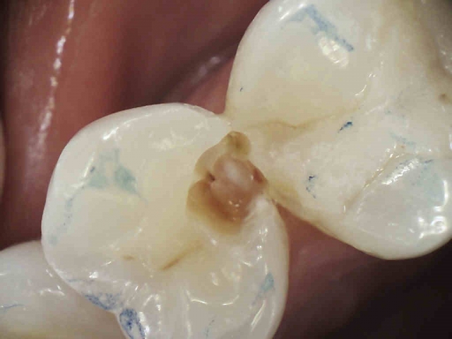 Caries Detection, Part I: What Do You See? image 13