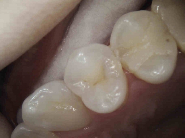 Caries Detection, Part I: What Do You See? image 14