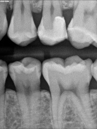 Caries Detection, Part I: What Do You See? image 15