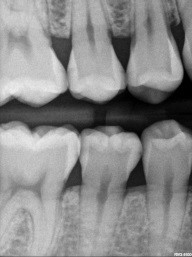 Caries Detection, Part I: What Do You See? image 16
