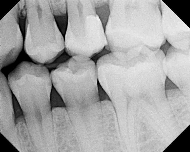 Caries Detection, Part I: What Do You See? image 17