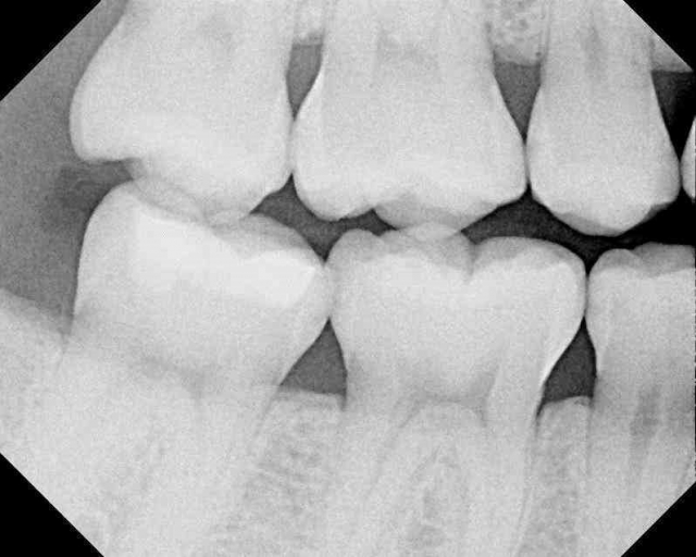 Caries Detection, Part I: What Do You See? image 18