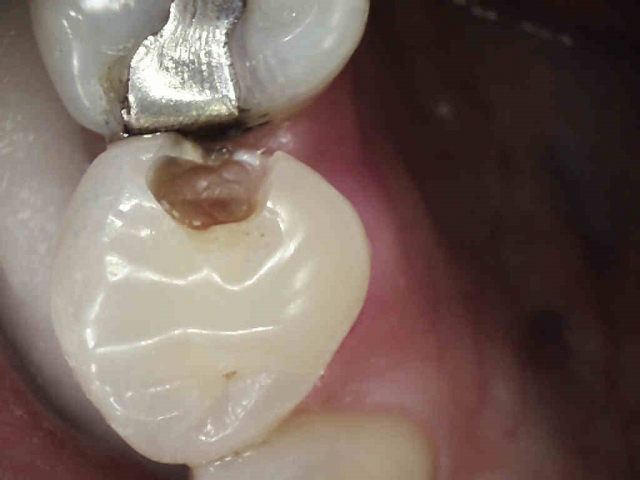 Caries Detection, Part I: What Do You See? image 19