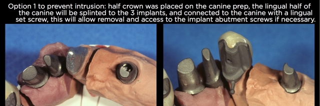 Connecting Teeth and Implants: Yes, No, Maybe? image 2