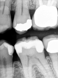 Caries Detection, Part I: What Do You See? image 20