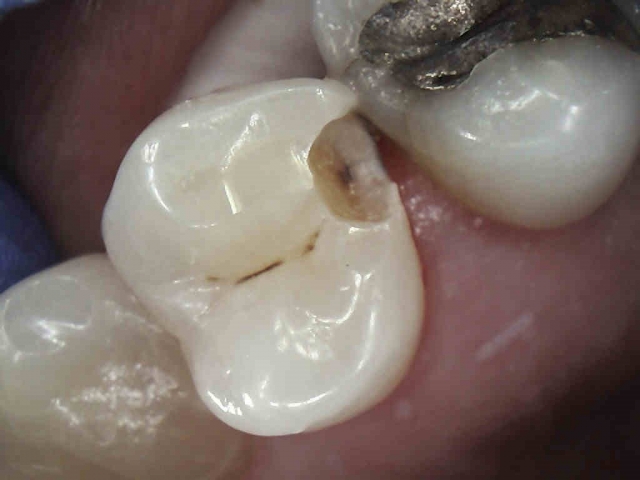 Caries Detection, Part I: What Do You See? image 21
