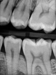 Caries Detection, Part I: What Do You See? image 22