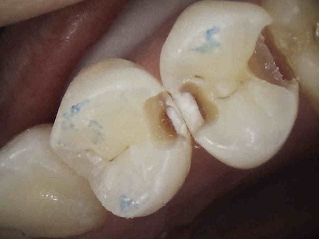 Caries Detection, Part I: What Do You See? image 23