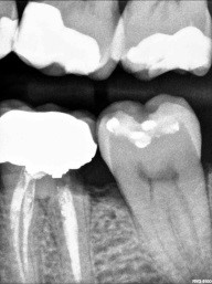 Caries Detection, Part I: What Do You See? image 24