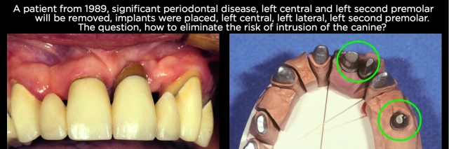 Connecting Teeth and Implants: Yes, No, Maybe? image 3