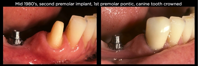 Connecting Teeth and Implants: Yes, No, Maybe? image 4