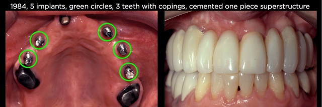 Connecting Teeth and Implants: Yes, No, Maybe? image 6