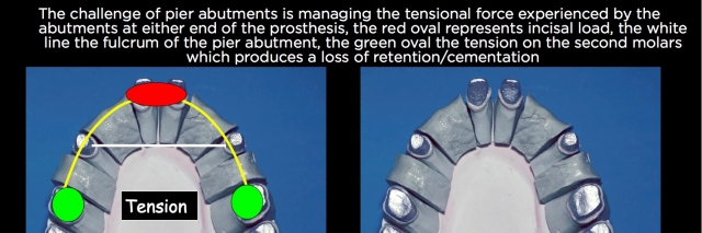 Connecting Teeth and Implants: Yes, No, Maybe? image 8