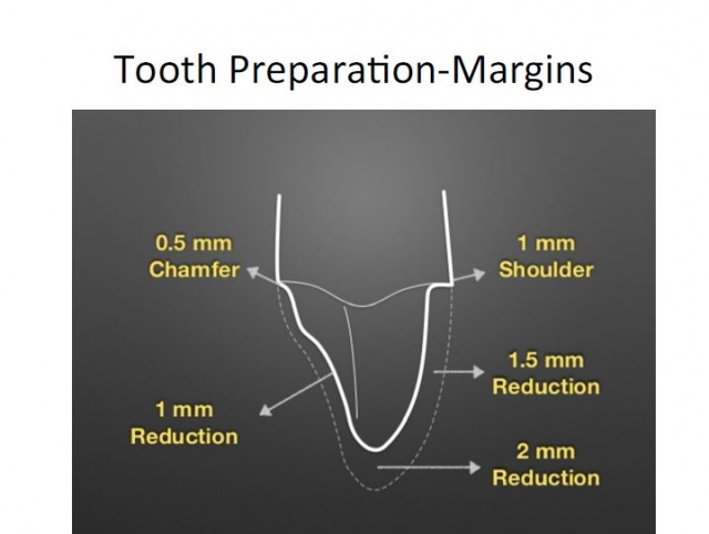 Crown Margin Preparation - Tools of the Trade image 2