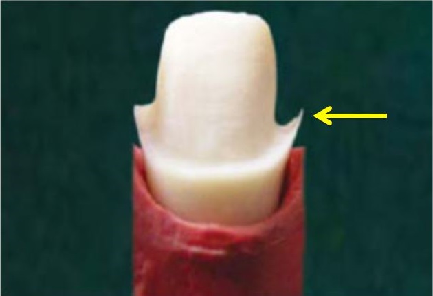 Crown Margin Preparation - Tools of the Trade image