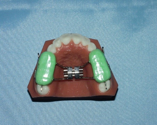5 Keys for Early Palatal Expansion DonnaStenberg 5 keys for early expansion Fig.2