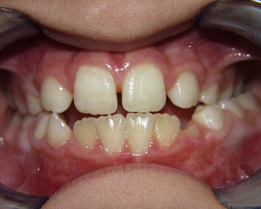 5 Keys for Early Palatal Expansion DonnaStenberg 5 keys for early expansion Fig.3