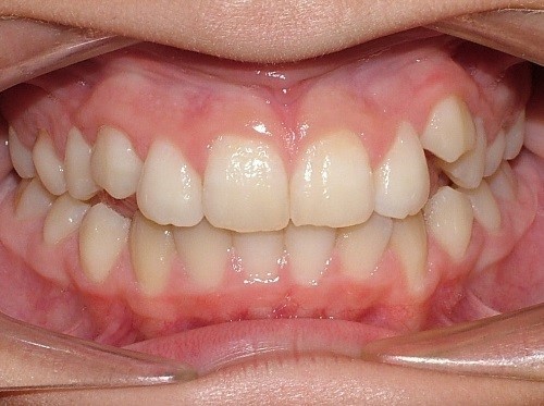 5 Keys for Early Palatal Expansion DonnaStenberg 5 keys for early expansion Fig.4