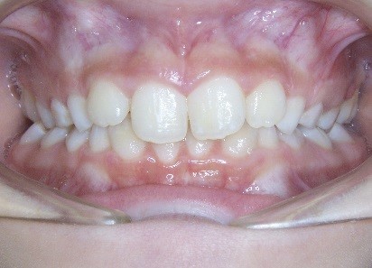 5 Keys for Early Palatal Expansion DonnaStenberg 5 keys for early expansion Fig.5