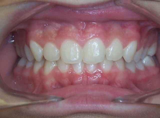 5 Keys for Early Palatal Expansion DonnaStenberg 5 keys for early expansion Fig.6