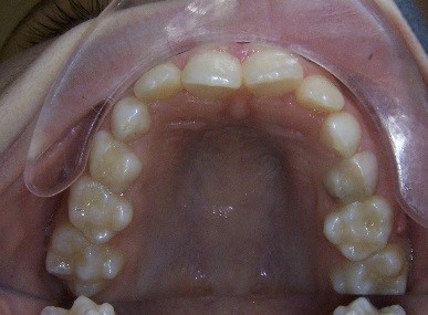 5 Keys for Early Palatal Expansion DonnaStenberg 5 keys for early expansion Fig.7