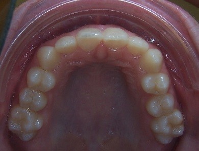 5 Keys for Early Palatal Expansion DonnaStenberg 5 keys for early expansion Fig.8