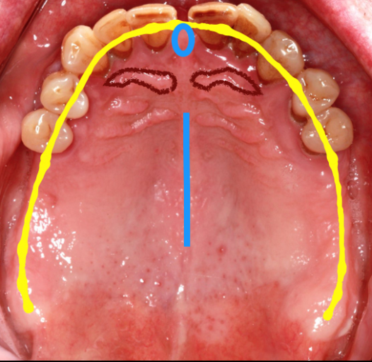 The 3 Best Times To Use Sectional Impression Techniques image 1