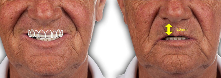 efrver Craniofacial landmarks and incisal edge measurement used to determine vertical dimension in dentistry