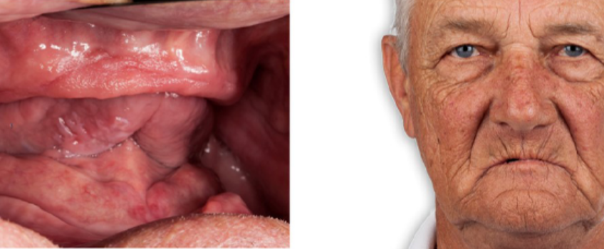 efrver Edentulous patient's intraoral ridges and facial profile used to evaluate vertical dimension in dentistry