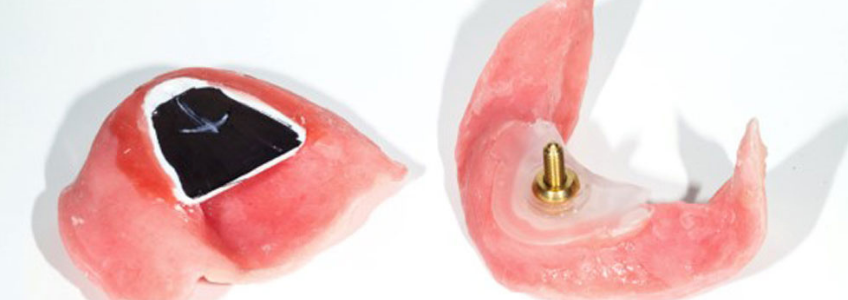 Vertical Dimension in Dentistry: Dentate and Edentulous Denture bases with an adjustable jackscrew device used for the tactile approach to vertical dimension in dentistry