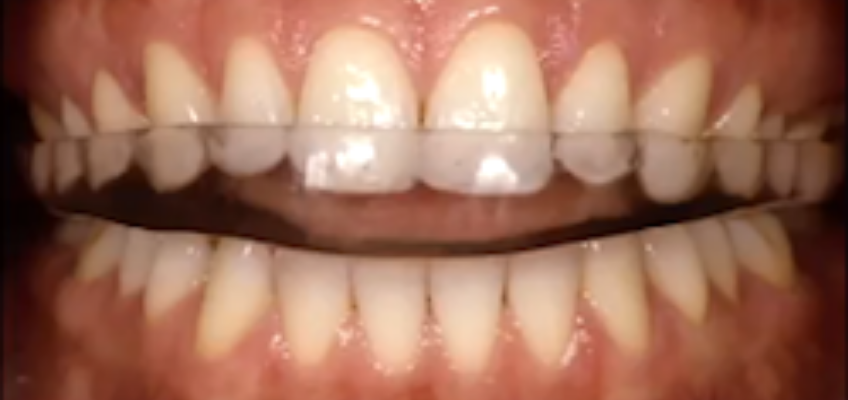 efrver Trial occlusal appliance used to evaluate vertical dimension in dentistry