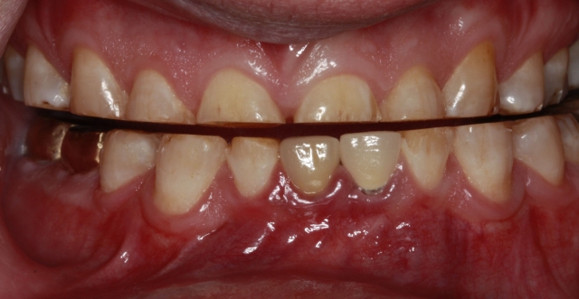 Anterior Guidance: Always, Never, Sometimes? DougBentig Anterior GuidanceAlways Never Sometimes Fig.1