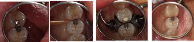 Indirect Pulp Capping image