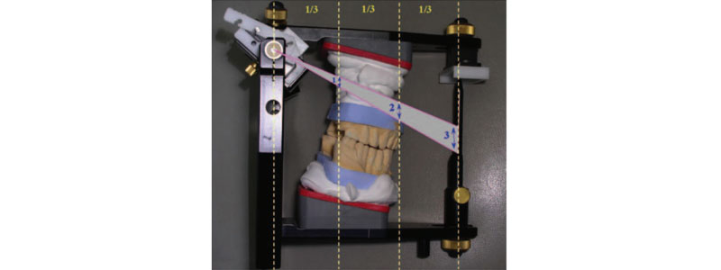 Taking the ‘Voodoo’ Out of Vertical Dimension of Occlusion Bonk taking voodoo vertical dimension 03