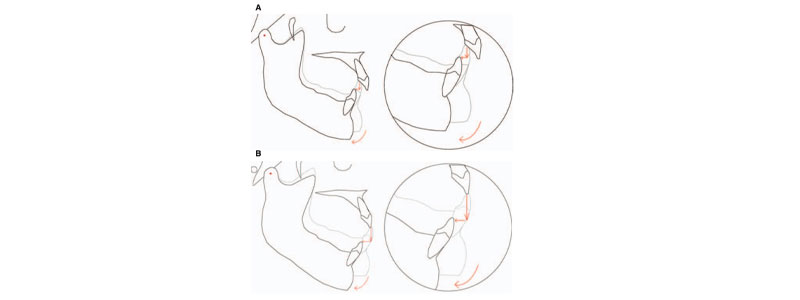 Taking the ‘Voodoo’ Out of Vertical Dimension of Occlusion Bonk taking voodoo vertical dimension 04