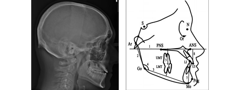 Taking the ‘Voodoo’ Out of Vertical Dimension of Occlusion Bonk taking voodoo vertical dimension 05