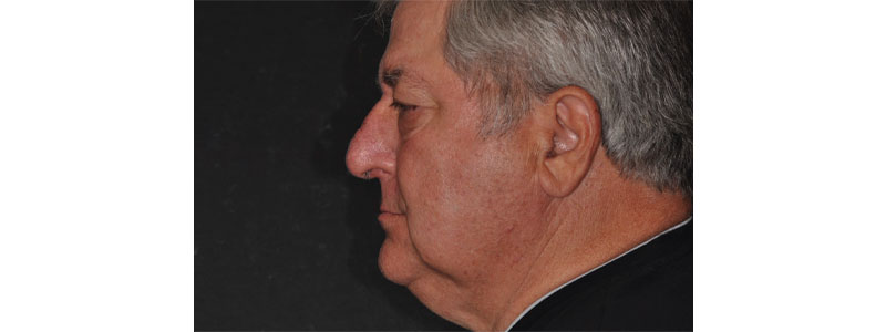 Taking the ‘Voodoo’ Out of Vertical Dimension of Occlusion Bonk taking voodoo vertical dimension 07