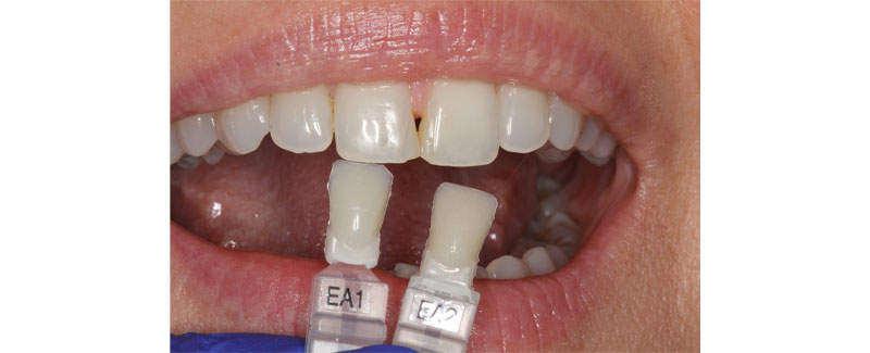 Color and Shade Selection for Anterior Composites image 2