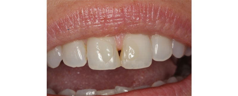 Color and Shade Selection for Anterior Composites image 3