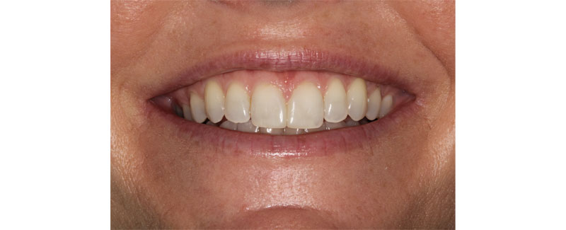 Color and Shade Selection for Anterior Composites image 4